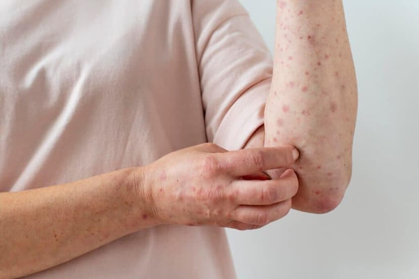 Skin Diseases